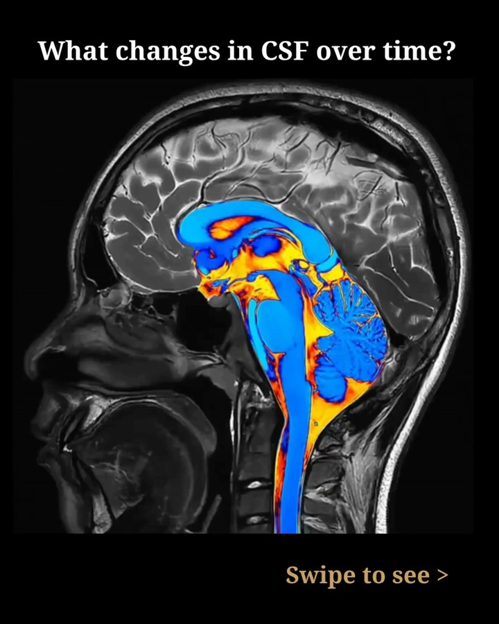 Preview of United Imaging’s CSF age-progression carousel showing a color-coded brain MRI.